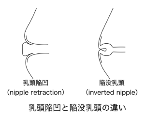 乳頭陥凹と陥没乳頭の違い